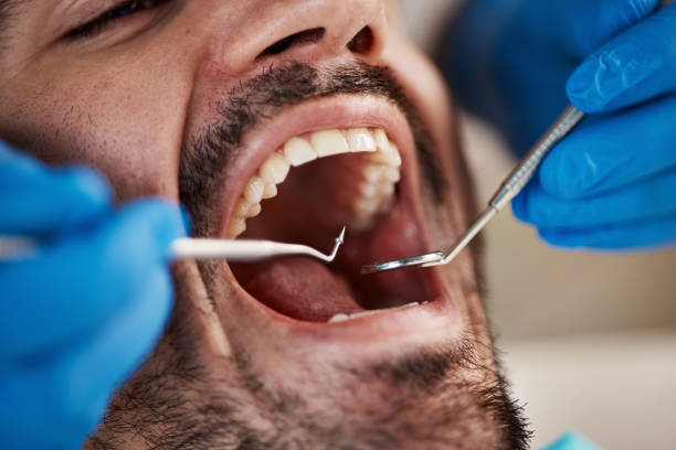 Best Emergency Dentist for Knocked-Out Tooth in University, FL